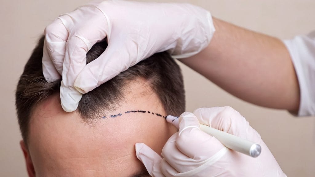 Hair Transplant in Turkey hair transplant in Turkey